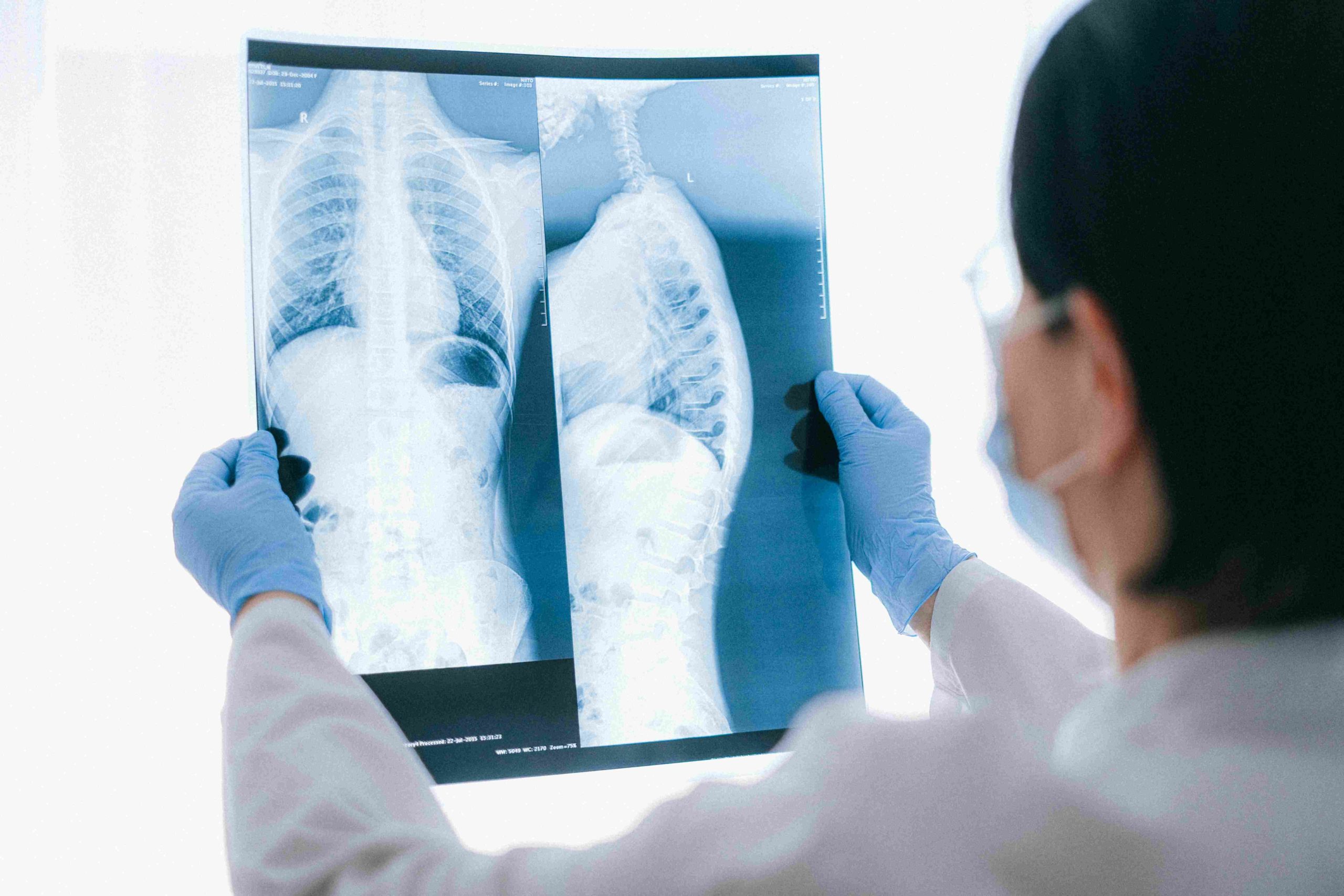 similarities of lung cancer and mesothelioma